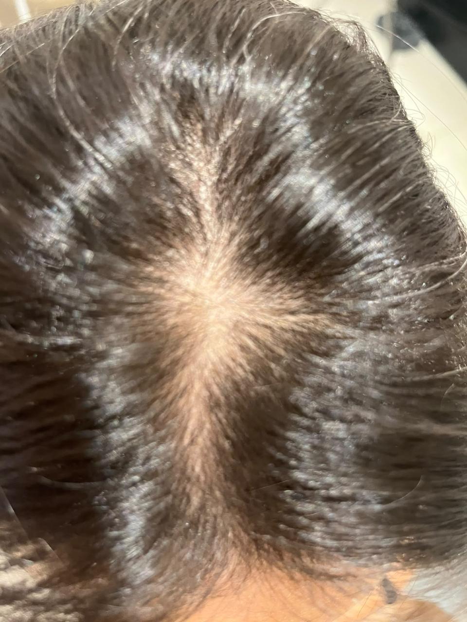 Couro cabeludo de cliente antes do uso do Shampoo Therapy